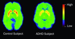 PET scans showing decreased levels of dopamine transporters in ADHD patients.
