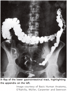 appendix x-ray