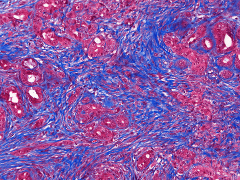 Non-cancerous stellate cells